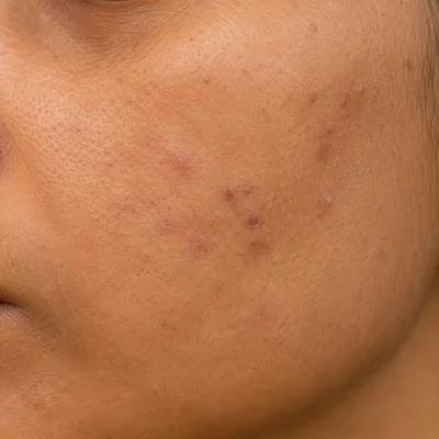 Blemish & Mark Care