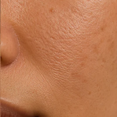 Dark spots